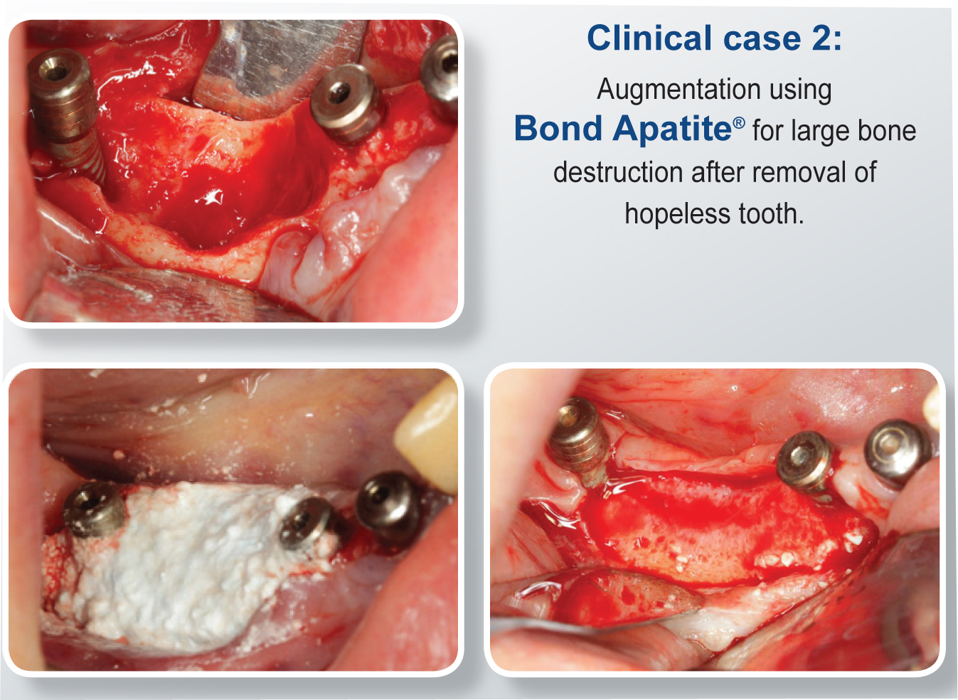 Bond Apatite Bone Graft Cement - Clinical Case