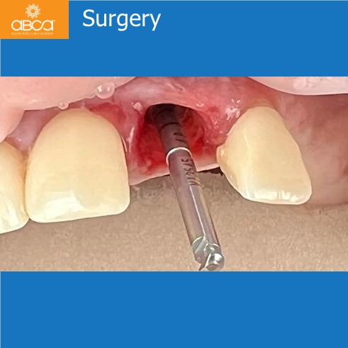 Extraction, Augma and Implants