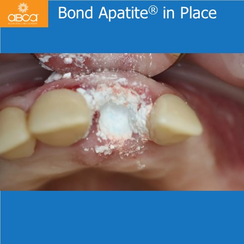 Extraction, Augma and Implants