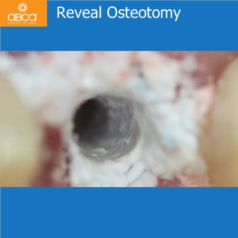 Extraction, Augma and Implants
