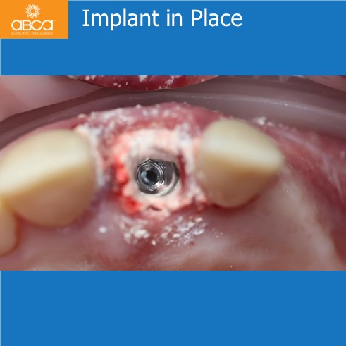 Extraction, Augma and Implants