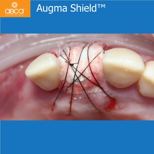 Extraction, Augma and Implants