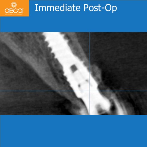 Extraction, Augma and Implants