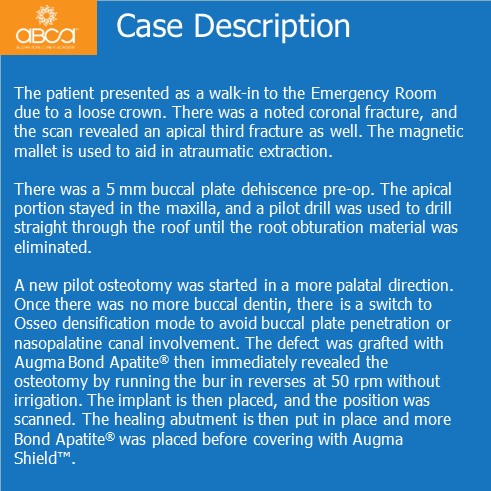 Extraction, Augma and Implants