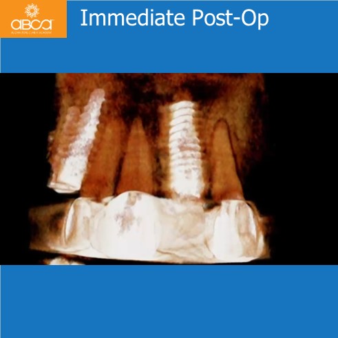 Extraction, Augma and Implants