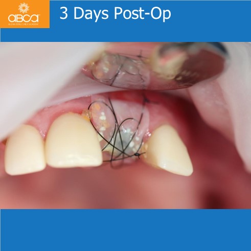 Extraction, Augma and Implants