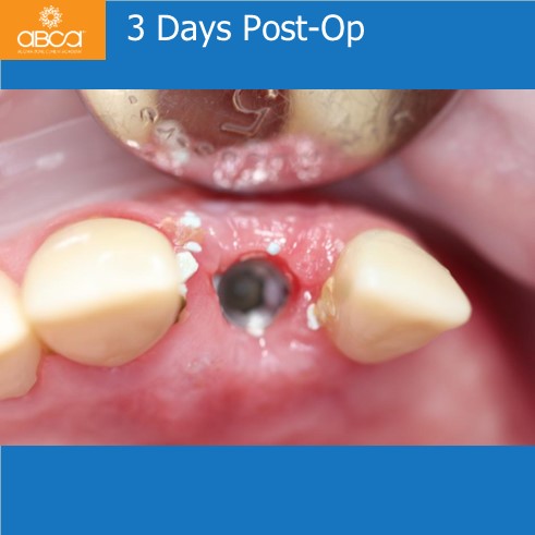 Extraction, Augma and Implants