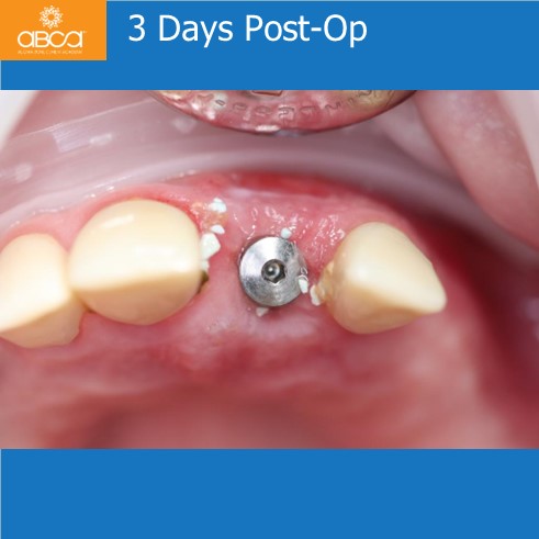 Extraction, Augma and Implants