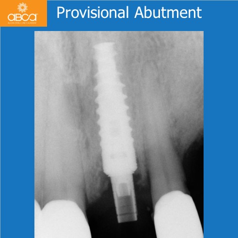 Extraction, Augma and Implants