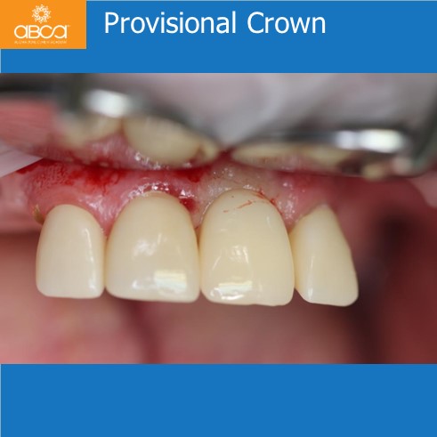 Extraction, Augma and Implants