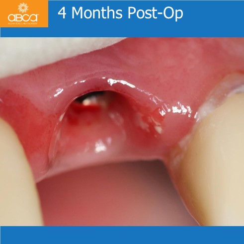 Extraction, Augma and Implants