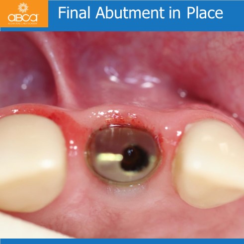 Extraction, Augma and Implants