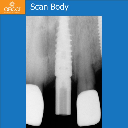Extraction, Augma and Implants