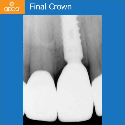 Extraction, Augma and Implants