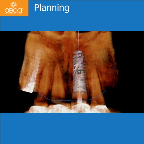 Extraction, Augma and Implants
