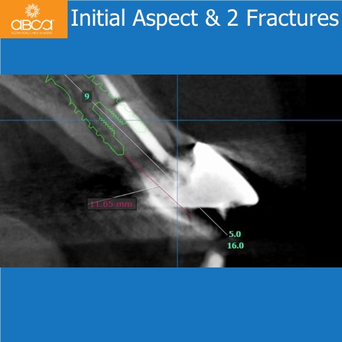 Extraction, Augma and Implants