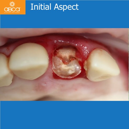 Extraction, Augma and Implants
