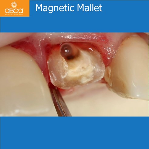 Extraction, Augma and Implants