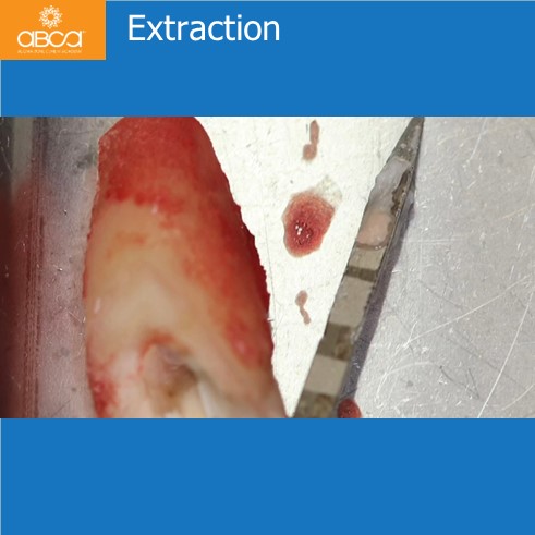 Extraction, Augma and Implants