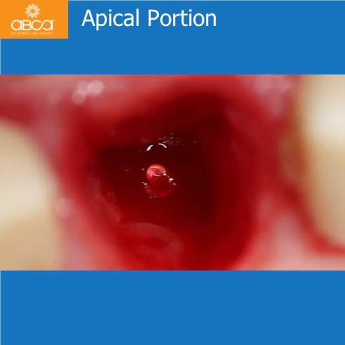 Extraction, Augma and Implants