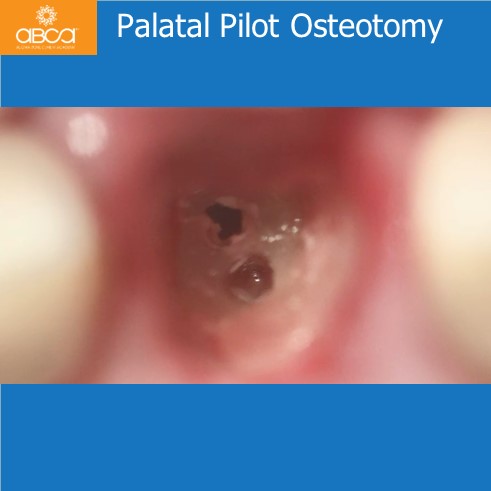 Extraction, Augma and Implants