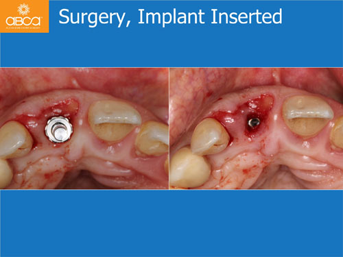 Immediate Implant with Immediate Load in the Aesthetic Zone