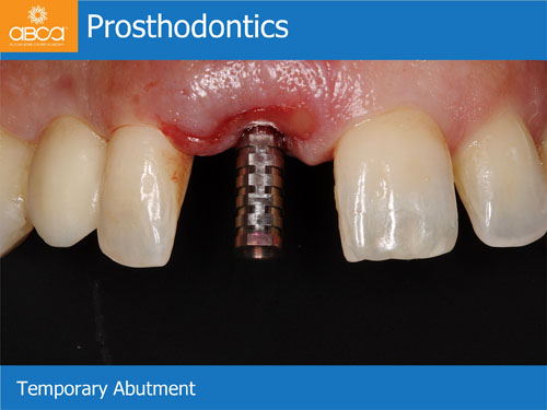 Immediate Implant with Immediate Load in the Aesthetic Zone