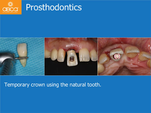 Immediate Implant with Immediate Load in the Aesthetic Zone