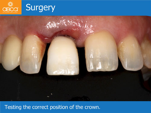 Immediate Implant with Immediate Load in the Aesthetic Zone