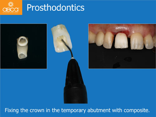 Immediate Implant with Immediate Load in the Aesthetic Zone