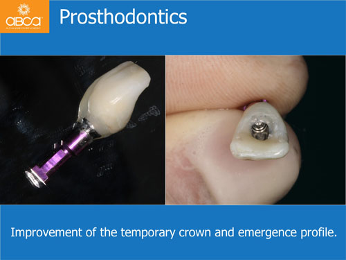 Immediate Implant with Immediate Load in the Aesthetic Zone