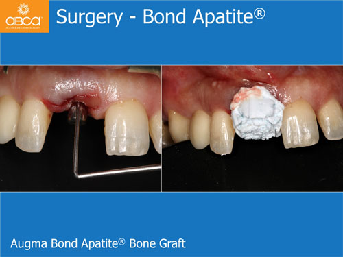 Immediate Implant with Immediate Load in the Aesthetic Zone