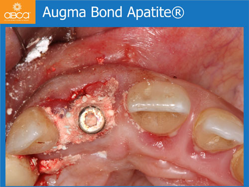 Immediate Implant with Immediate Load in the Aesthetic Zone