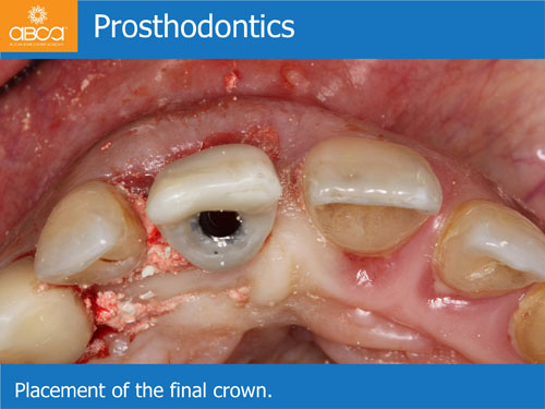 Immediate Implant with Immediate Load in the Aesthetic Zone