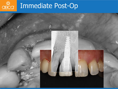 Immediate Implant with Immediate Load in the Aesthetic Zone