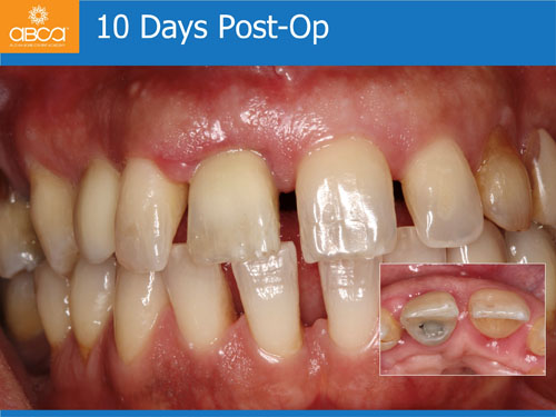 Immediate Implant with Immediate Load in the Aesthetic Zone