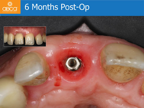 Immediate Implant with Immediate Load in the Aesthetic Zone