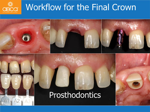 Immediate Implant with Immediate Load in the Aesthetic Zone