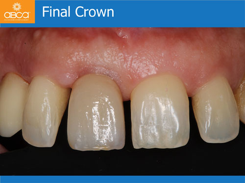 Immediate Implant with Immediate Load in the Aesthetic Zone