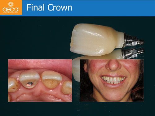 Immediate Implant with Immediate Load in the Aesthetic Zone