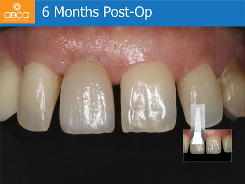 Immediate Implant with Immediate Load in the Aesthetic Zone