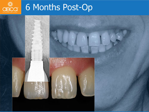 Immediate Implant with Immediate Load in the Aesthetic Zone