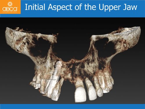 Immediate Implant with Immediate Load in the Aesthetic Zone