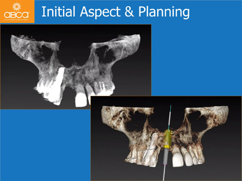 Immediate Implant with Immediate Load in the Aesthetic Zone