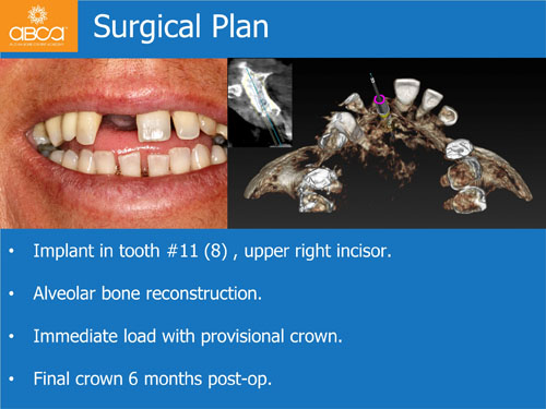 Immediate Implant with Immediate Load in the Aesthetic Zone