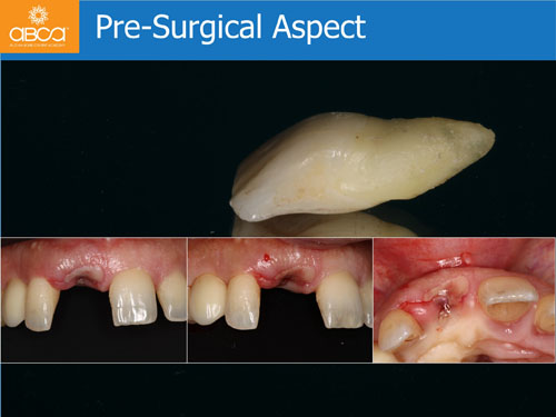 Immediate Implant with Immediate Load in the Aesthetic Zone