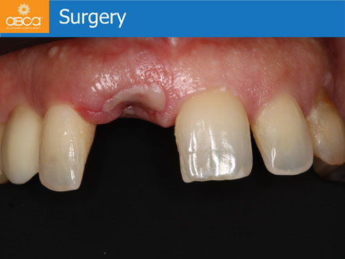 Immediate Implant with Immediate Load in the Aesthetic Zone