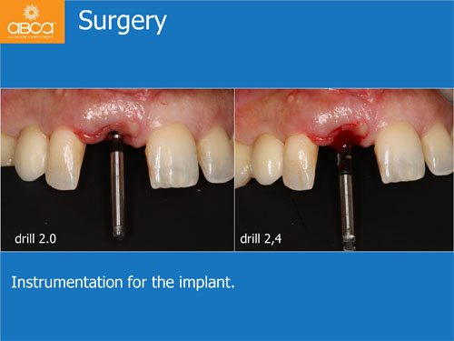 Immediate Implant with Immediate Load in the Aesthetic Zone