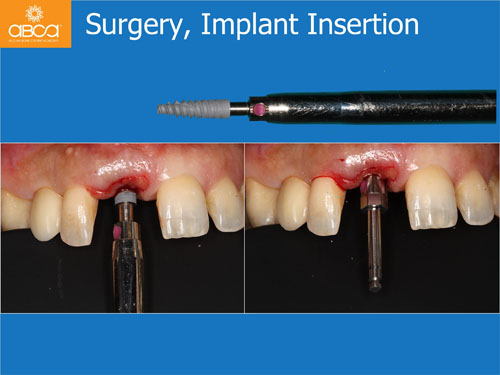 Immediate Implant with Immediate Load in the Aesthetic Zone