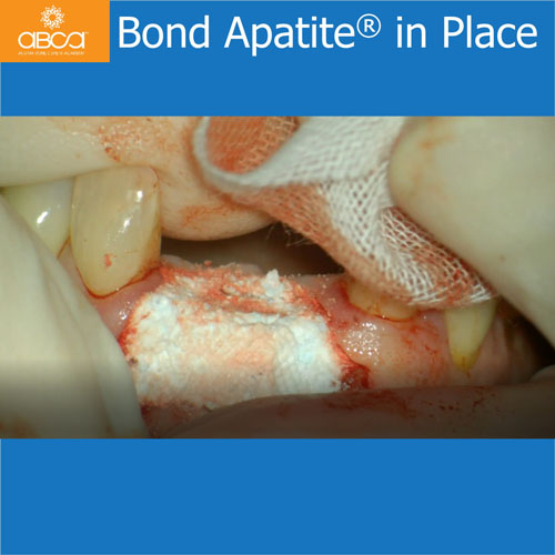 Upper Central Incisors, Augmentation and Implants